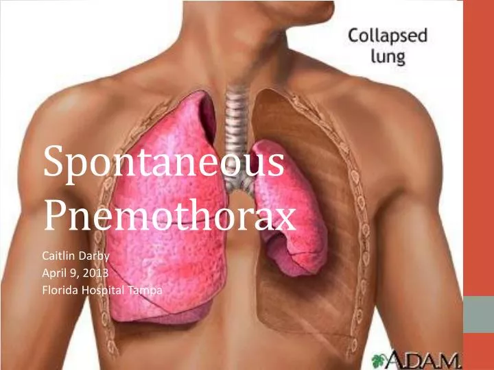 spontaneous pnemothorax