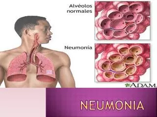 neumonia