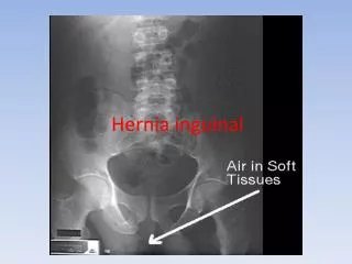 hernia inguinal