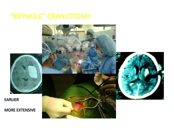 keyhole craniotomy