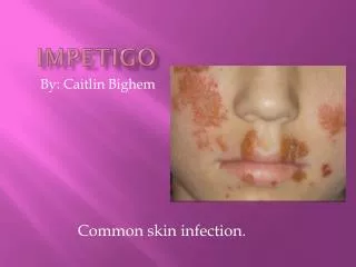 impetigo