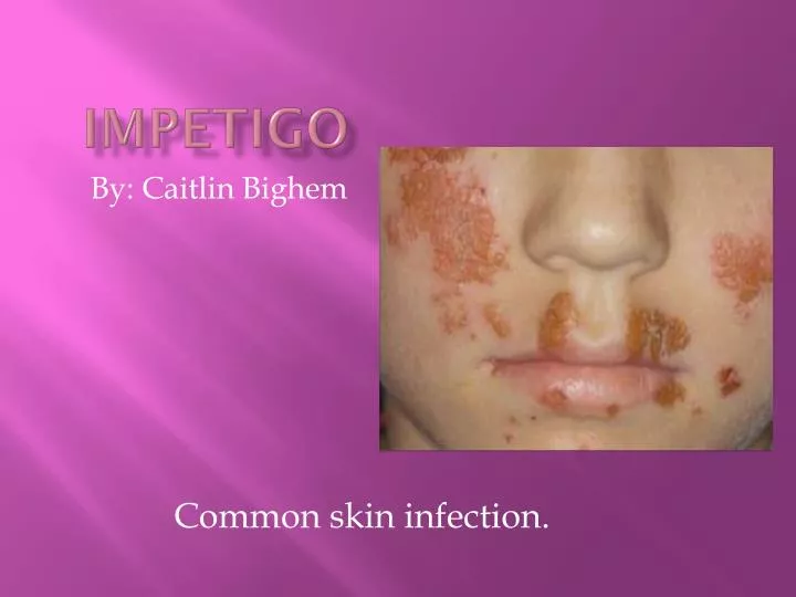 impetigo