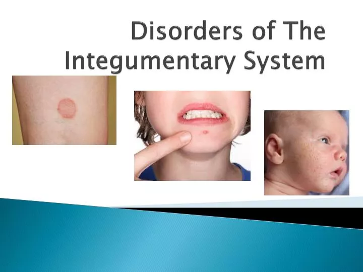 disorders of the integumentary system