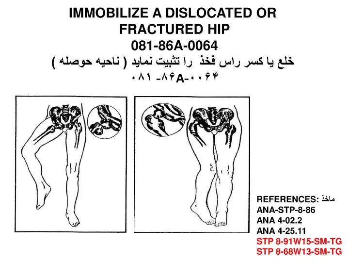 immobilize a dislocated or fractured hip 081 86a 0064 a