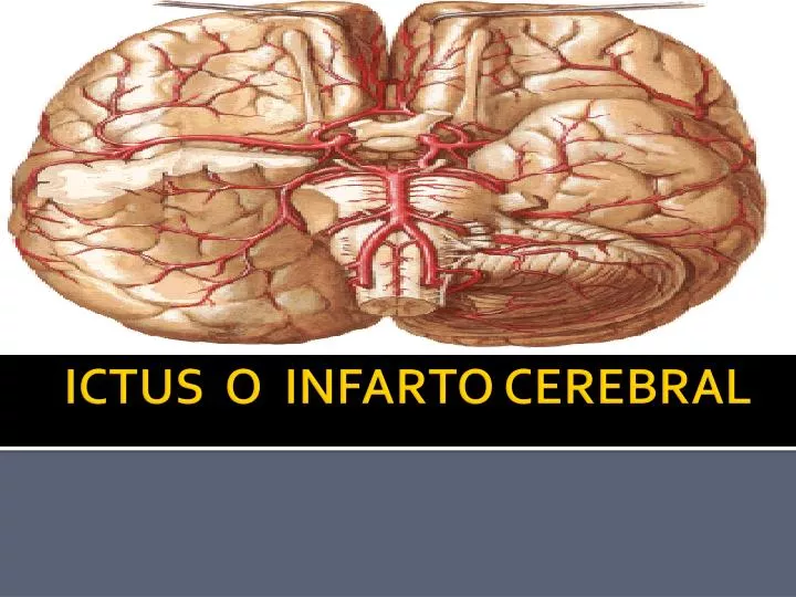 ictus o infarto cerebral