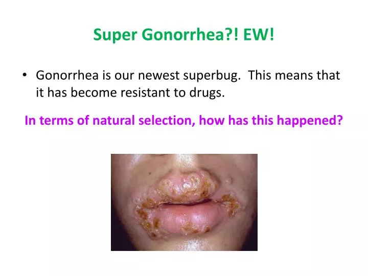 super gonorrhea ew