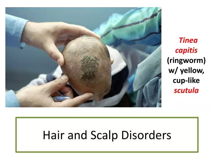 hair and scalp disorders