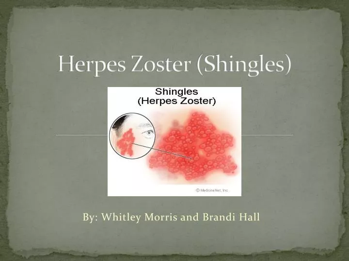 herpes zoster shingles