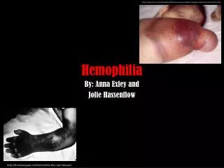 Hemophilia