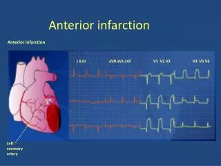 anterior infarction