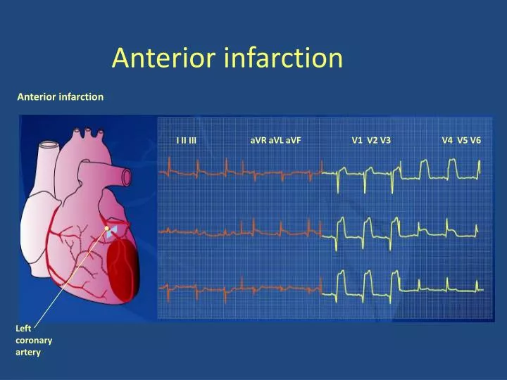 anterior infarction