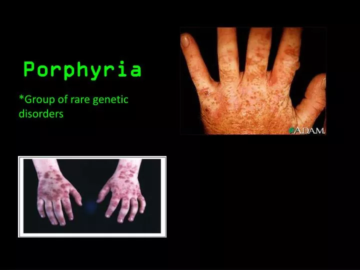 porphyria