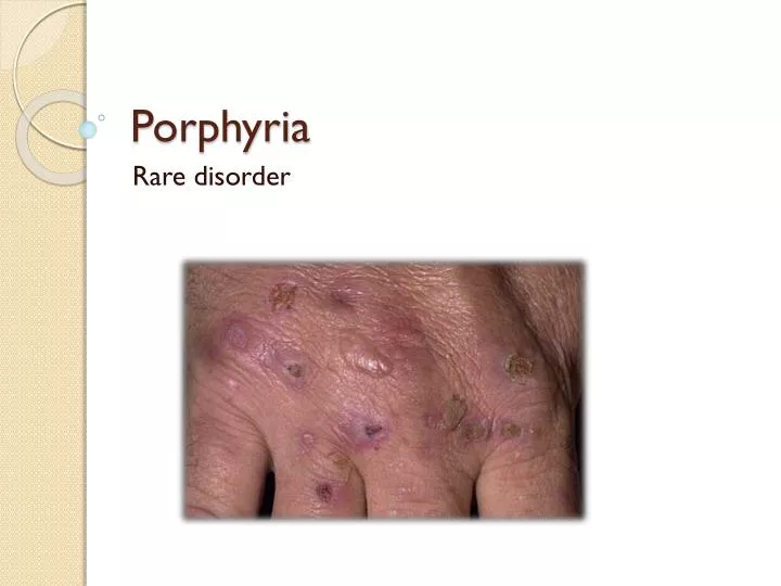 p orphyria