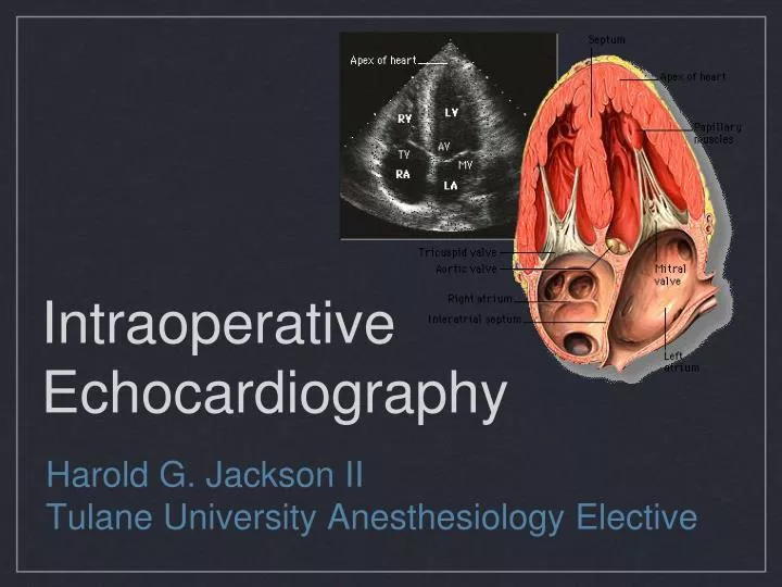 intraoperative echocardiography