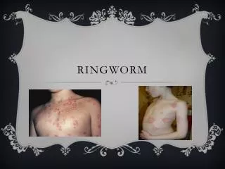 Ringworm