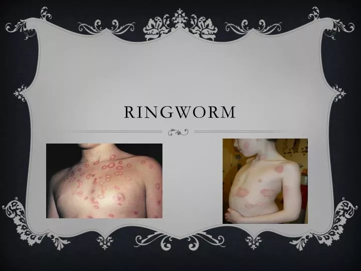 ringworm