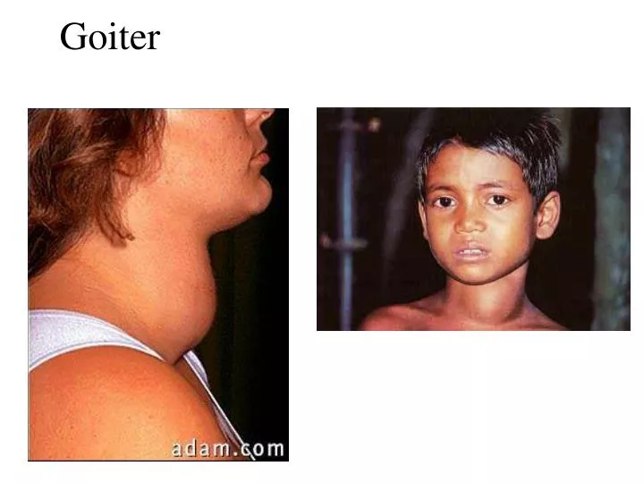 goiter