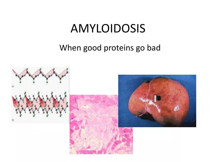 amyloidosis