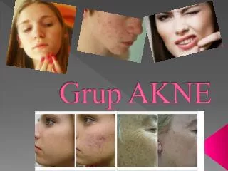 grup akne