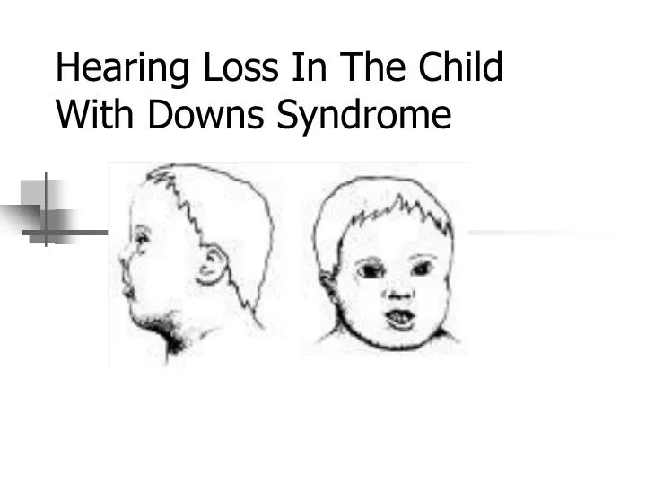 hearing loss in the child with downs syndrome