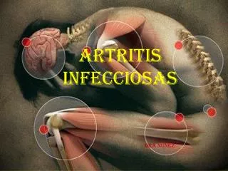 artritis infecciosas