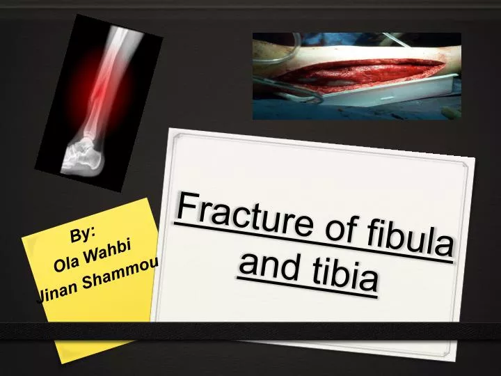 fracture of fibula and tibia