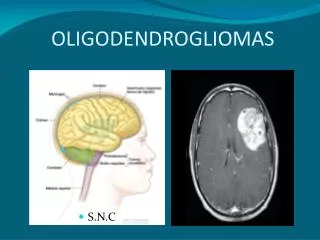oligodendrogliomas