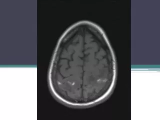 Cerebral Vein Thrombosis