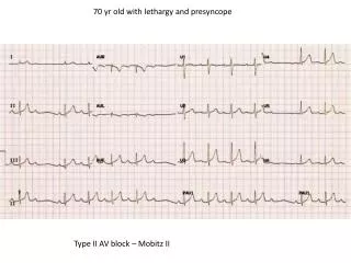 70 yr old with lethargy and presyncope