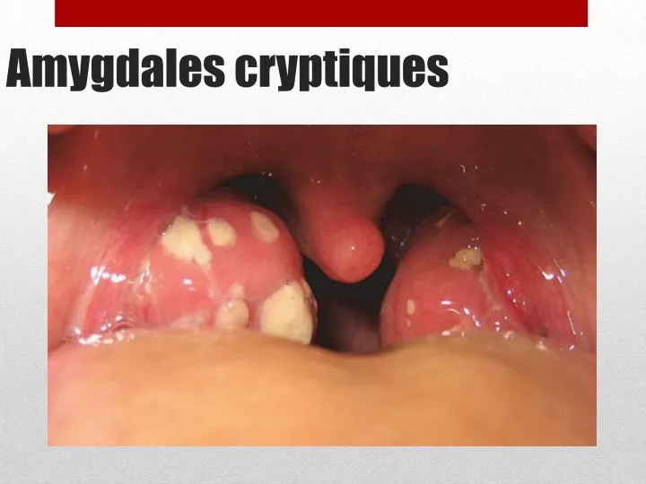 amygdales cryptiques