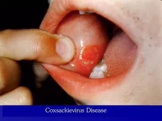 Coxsackievirus Disease