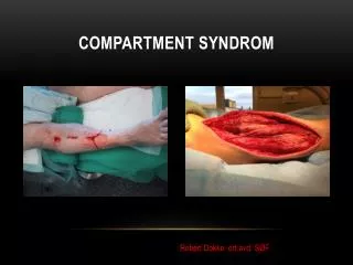 compartment syndrom