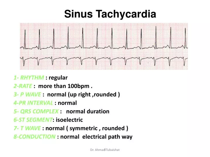 sinus tachycardia