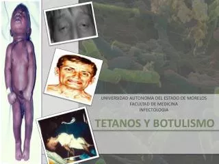 TETANOS Y BOTULISMO