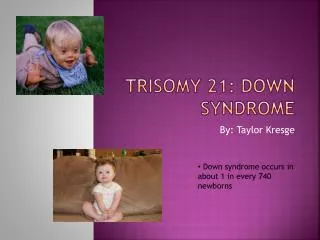 Trisomy 21: Down Syndrome