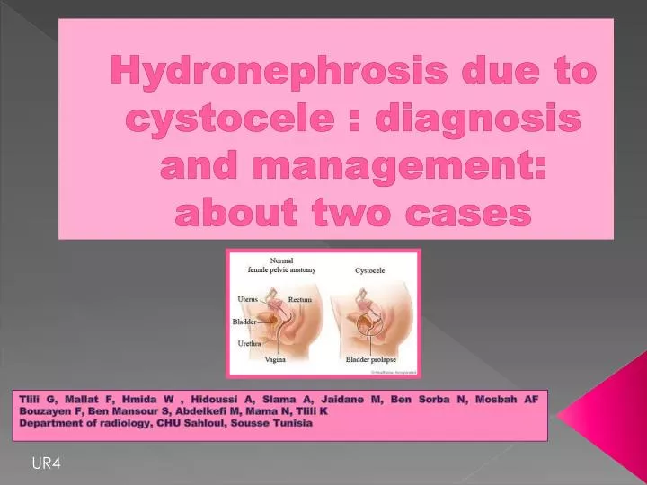 hydronephrosis due to cystocele diagnosis and management about two cases