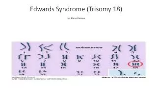 Edwards Syndrome (Trisomy 18) by: Karen Guzman