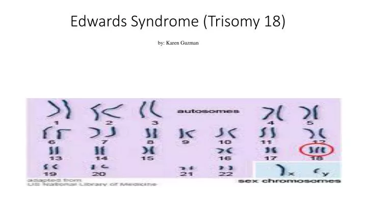 edwards syndrome trisomy 18 by karen guzman