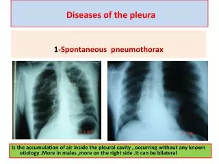 Diseases of the pleura
