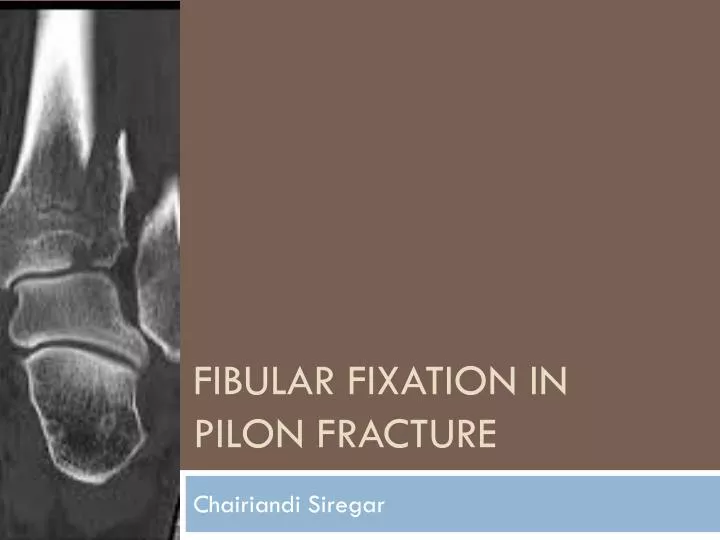 fibular fixation in pilon f racture