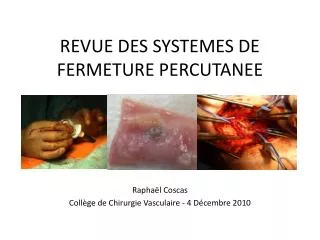 revue des systemes de fermeture percutanee