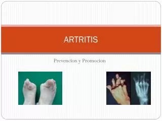 artritis