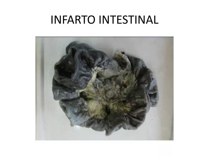 infarto intestinal