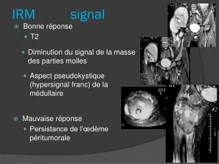 irm signal