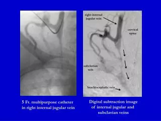 5 Fr. multipurpose catheter in right internal jugular vein