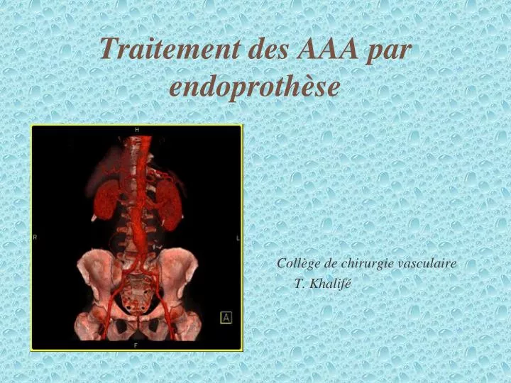 traitement des aaa par endoproth se