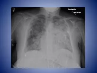 Peripartum Cardiomyopathy