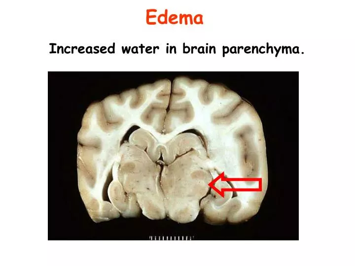 edema