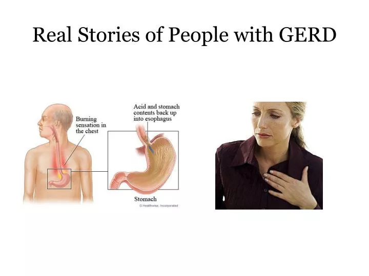 real stories of people with gerd