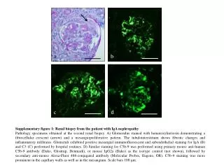 Supplementary figure 1 : Renal biopsy from the patient with IgA nephropathy